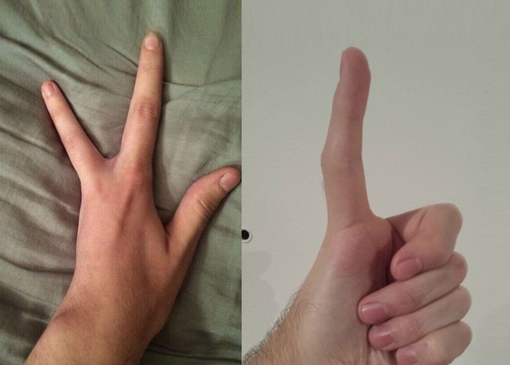 People Share The Most Unusual Body Parts They Were Born With And The Internet Went Wild